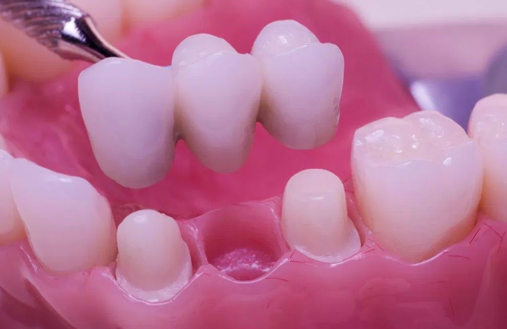 Fixed Partial Dentures