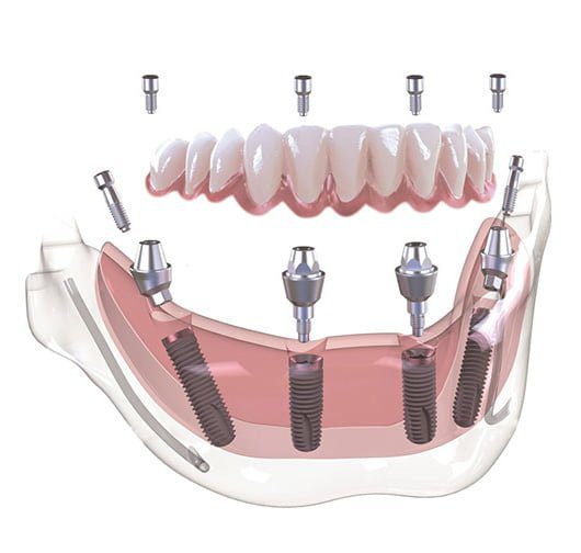 Conventional Dental Implants - April 2024