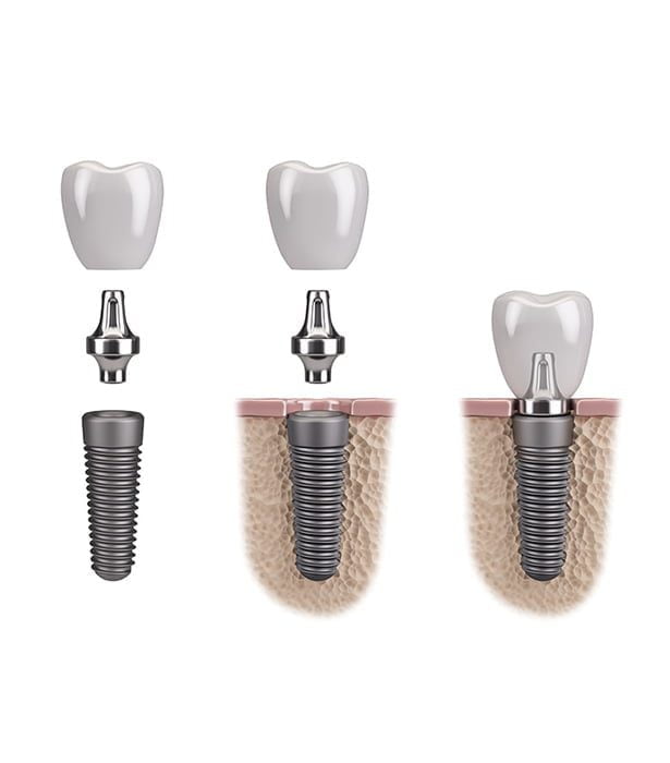 conve Conventional Dental Implants - September 2023