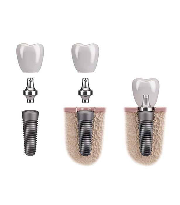 Conventional Dental Implants - April 2024