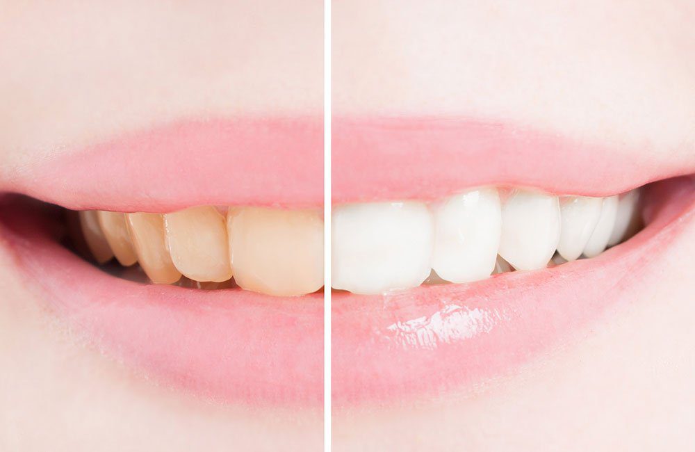 PROFESSIONAL TOOTH WHITENING