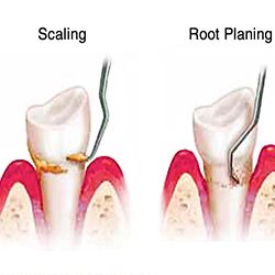 Dental Scaling Treatment