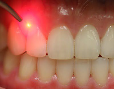 Laser Dentistry