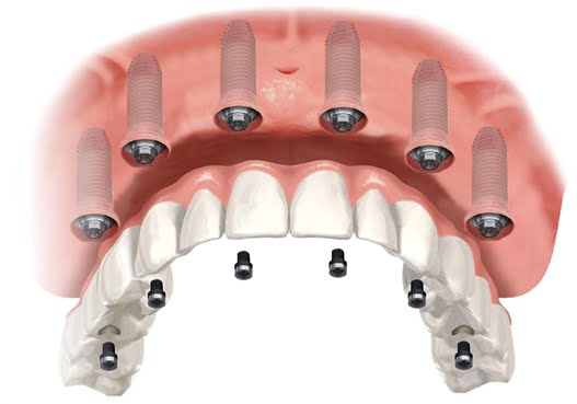 All-on-6 Dental Implants, Kokapet and Narsingi, Hyderabad