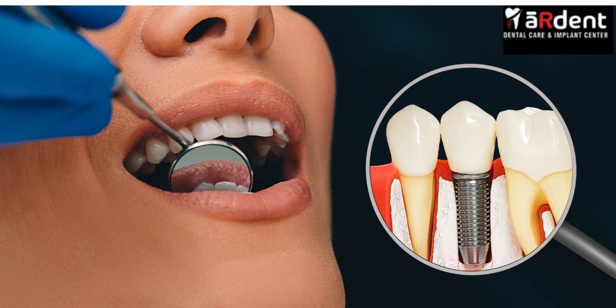 full Mouth Dental Implants