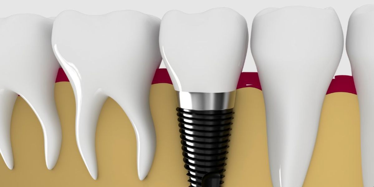 Dental Implants